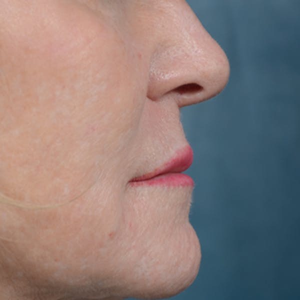 Lip Lift Before & After Gallery - Patient 16861941 - Image 5