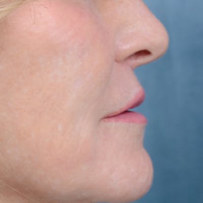 Lip Lift Before & After Gallery - Patient 16861941 - Image 6