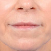 Lip Lift Before & After Gallery - Patient 41510471 - Image 1