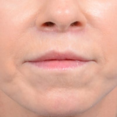 Lip Lift Before & After Gallery - Patient 41510471 - Image 2