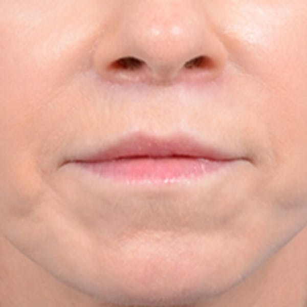 Lip Lift Before & After Gallery - Patient 41510471 - Image 2