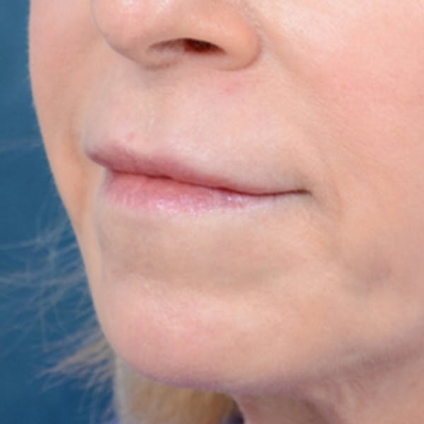 Lip Lift Before & After Gallery - Patient 41510471 - Image 3