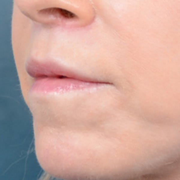 Lip Lift Before & After Gallery - Patient 41510471 - Image 4