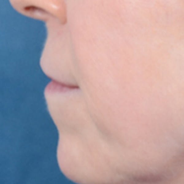 Lip Lift Before & After Gallery - Patient 41510471 - Image 5