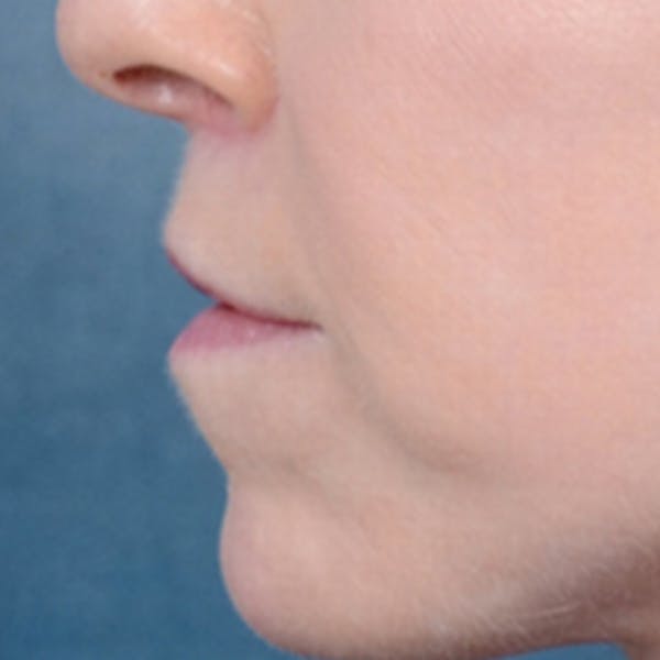 Lip Lift Before & After Gallery - Patient 41510471 - Image 6