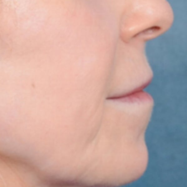 Lip Lift Before & After Gallery - Patient 41510471 - Image 9