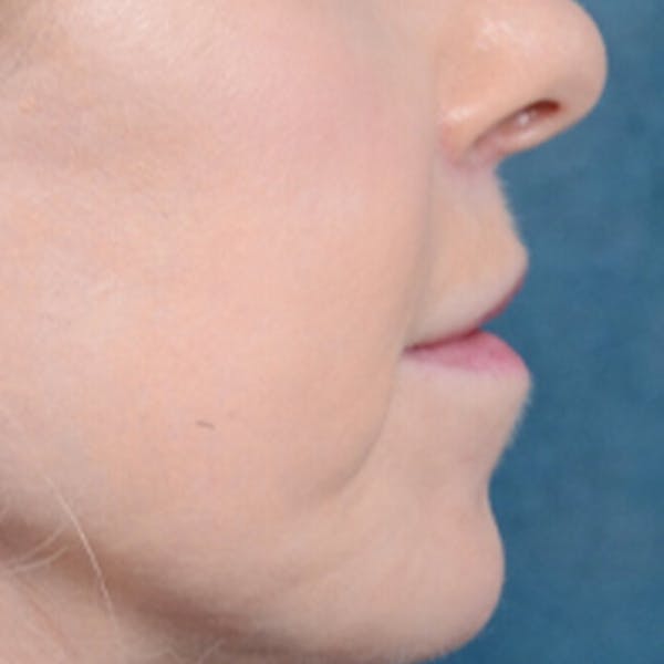 Lip Lift Before & After Gallery - Patient 41510471 - Image 10