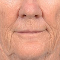 Lip Lift Before & After Gallery - Patient 146899006 - Image 1