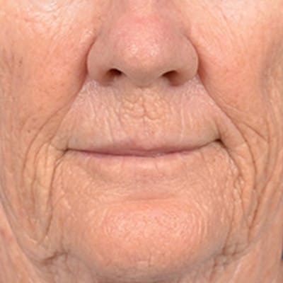 Lip Lift Before & After Gallery - Patient 146899006 - Image 1