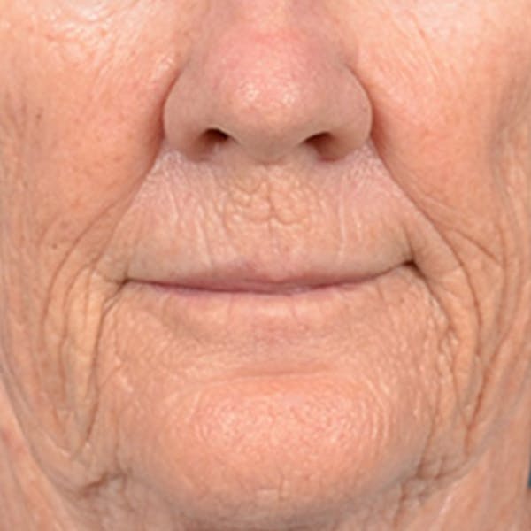 Lip Lift Before & After Gallery - Patient 146899006 - Image 1