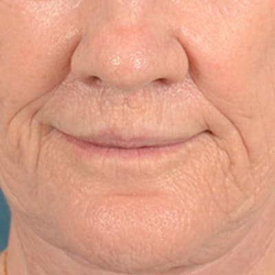 Lip Lift Before & After Gallery - Patient 146899006 - Image 2