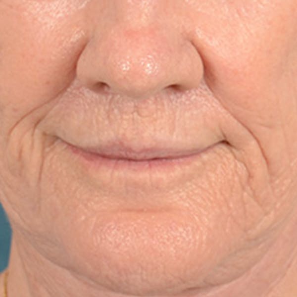 Lip Lift Before & After Gallery - Patient 146899006 - Image 2