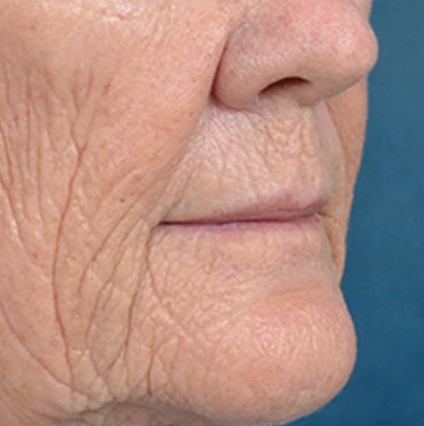 Lip Lift Before & After Gallery - Patient 146899006 - Image 3