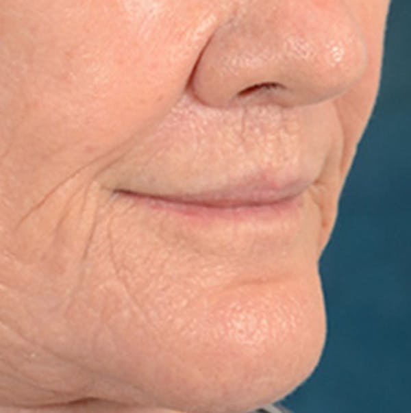 Lip Lift Before & After Gallery - Patient 146899006 - Image 4