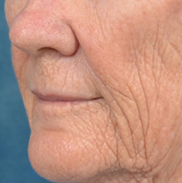 Lip Lift Before & After Gallery - Patient 146899006 - Image 7