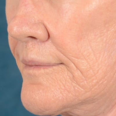 Lip Lift Before & After Gallery - Patient 146899006 - Image 8