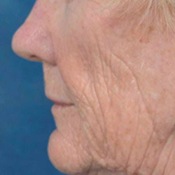 Lip Lift Before & After Gallery - Patient 146899006 - Image 9