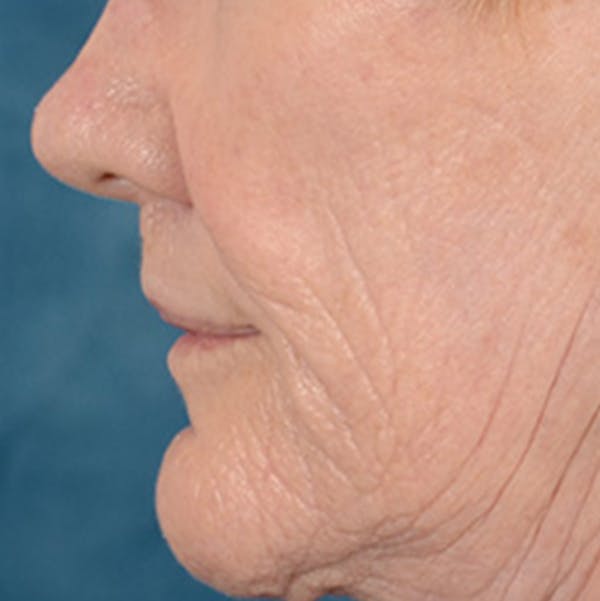 Lip Lift Before & After Gallery - Patient 146899006 - Image 10