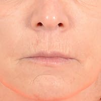Lip Lift Before & After Gallery - Patient 169365984 - Image 1