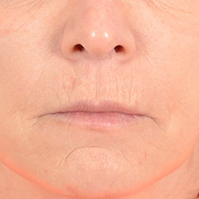 Lip Lift Before & After Gallery - Patient 169365984 - Image 1