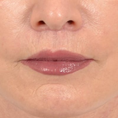 Lip Lift Before & After Gallery - Patient 169365984 - Image 2