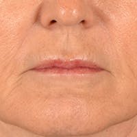 Lip Lift Before & After Gallery - Patient 796520 - Image 1