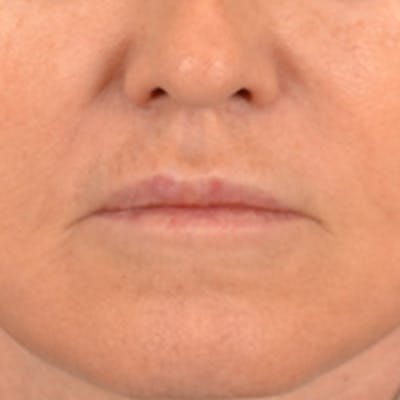 Lip Lift Before & After Gallery - Patient 796520 - Image 2