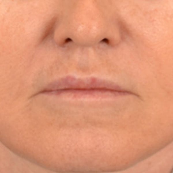 Lip Lift Before & After Gallery - Patient 796520 - Image 2