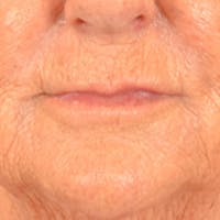 Lip Lift Before & After Gallery - Patient 139841 - Image 1