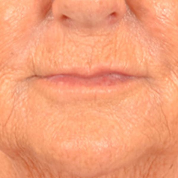 Lip Lift Before & After Gallery - Patient 139841 - Image 1