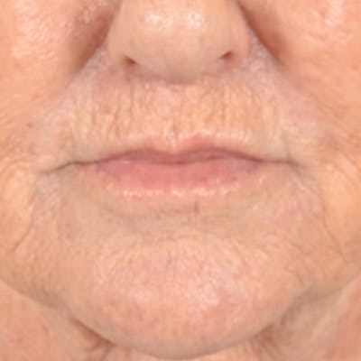 Lip Lift Before & After Gallery - Patient 139841 - Image 2