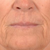 Lip Lift Before & After Gallery - Patient 257081 - Image 1