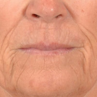 Lip Lift Before & After Gallery - Patient 257081 - Image 1