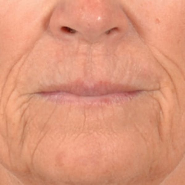 Lip Lift Before & After Gallery - Patient 257081 - Image 1