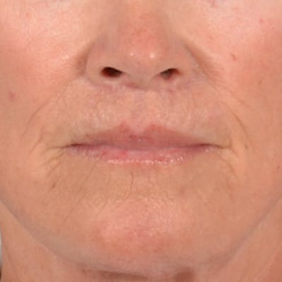 Lip Lift Before & After Gallery - Patient 257081 - Image 2