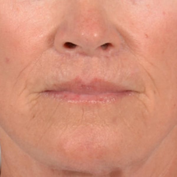Lip Lift Before & After Gallery - Patient 257081 - Image 2