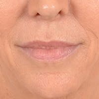Lip Lift Before & After Gallery - Patient 194471 - Image 1