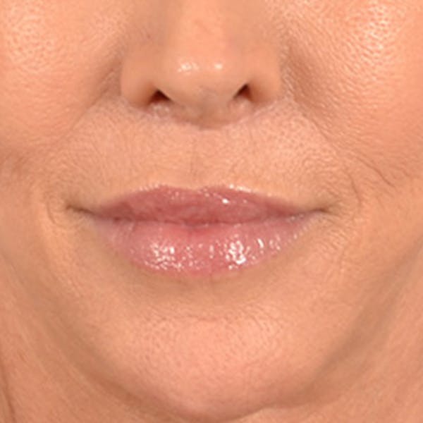 Lip Lift Before & After Gallery - Patient 194471 - Image 2