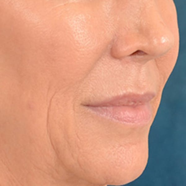 Lip Lift Before & After Gallery - Patient 194471 - Image 3