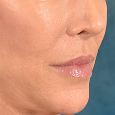 Lip Lift Before & After Gallery - Patient 194471 - Image 4