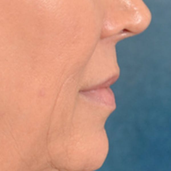 Lip Lift Before & After Gallery - Patient 194471 - Image 5