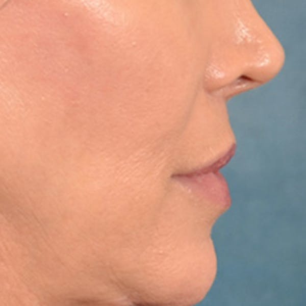 Lip Lift Before & After Gallery - Patient 194471 - Image 6