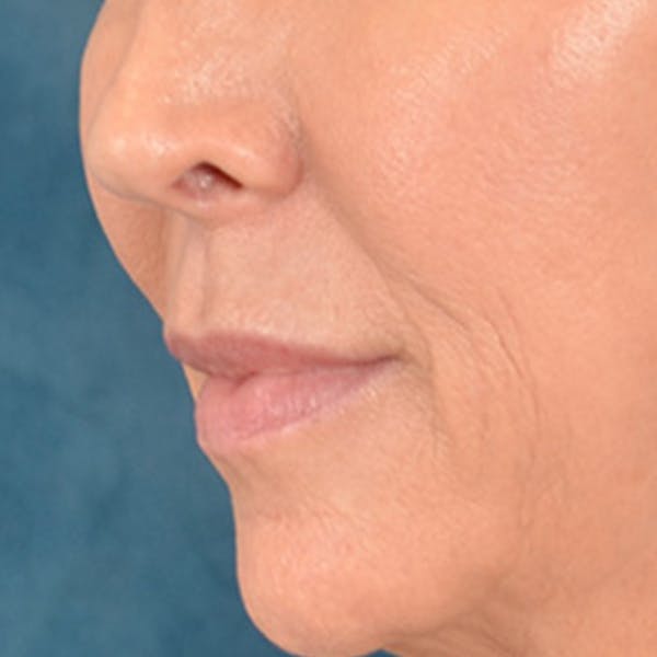 Lip Lift Before & After Gallery - Patient 194471 - Image 7