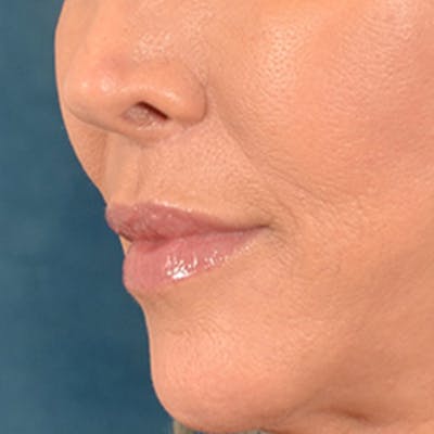 Lip Lift Before & After Gallery - Patient 194471 - Image 8