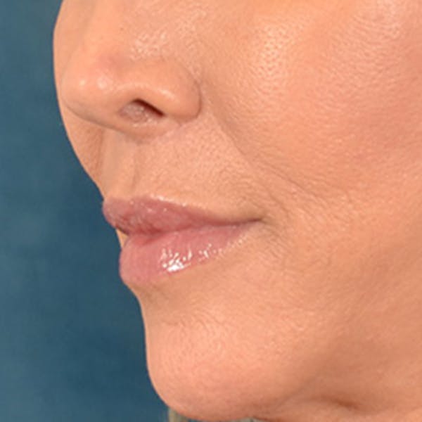 Lip Lift Before & After Gallery - Patient 194471 - Image 8