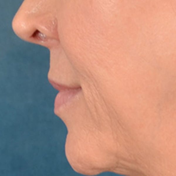 Lip Lift Before & After Gallery - Patient 194471 - Image 9