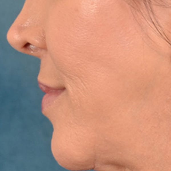 Lip Lift Before & After Gallery - Patient 194471 - Image 10