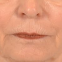 Lip Lift Before & After Gallery - Patient 218091 - Image 1