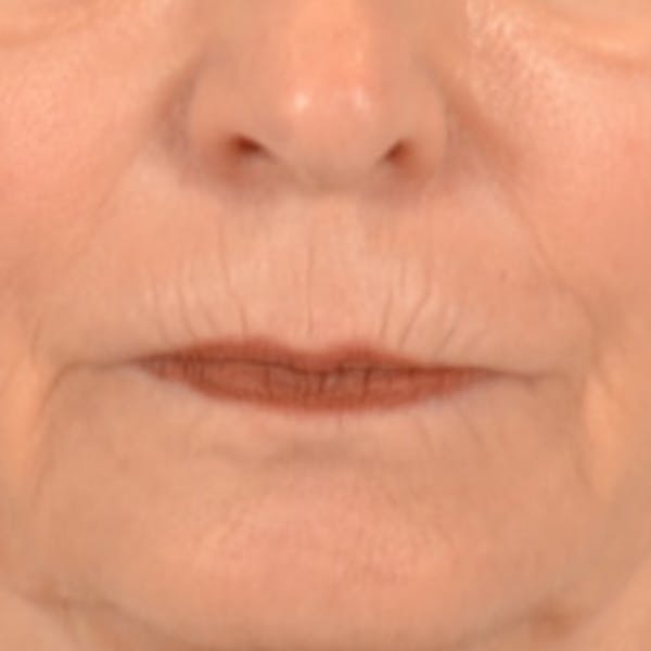 Lip Lift Before & After Gallery - Patient 218091 - Image 1