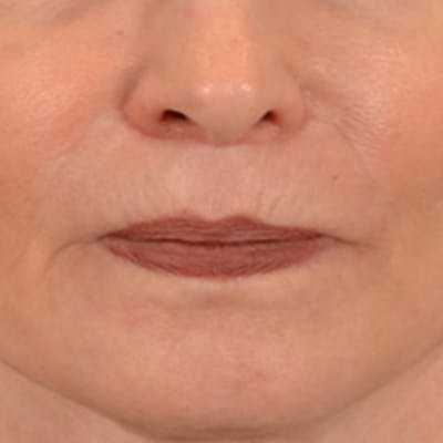 Lip Lift Before & After Gallery - Patient 218091 - Image 2
